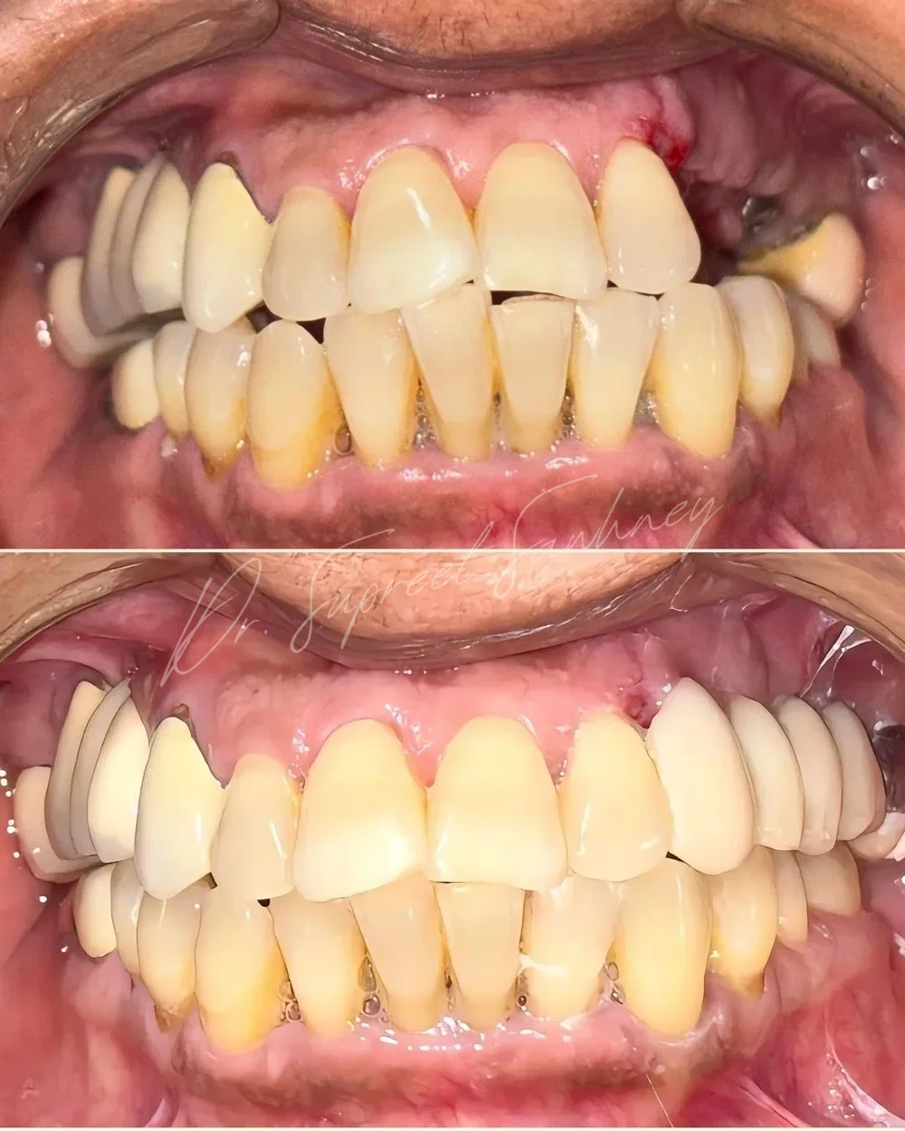 Before-and-after frontal intraoral photographs from a multiple-implant restorative rehabilitation case